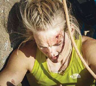 אחרי פציעת הראש // צילום: אינסטגרם