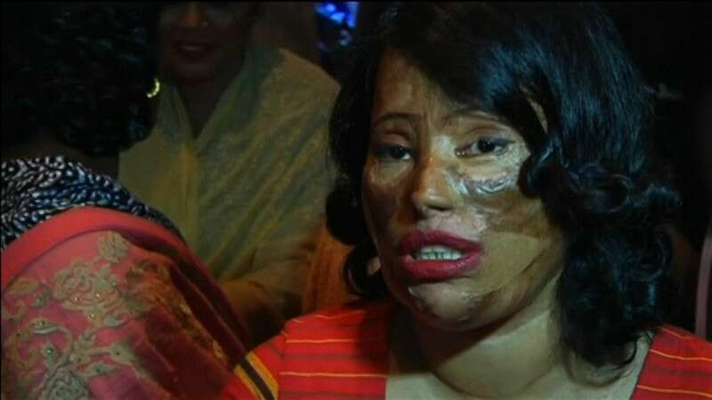 השחתה פיזית והשפלה פסיכולוגית, קורבן מתקפת חומצה // צילום: רויטרס