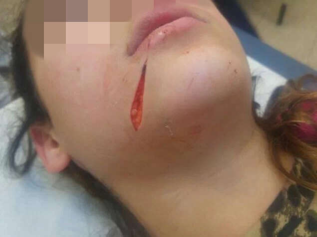 הפציעה על פניה של הילדה