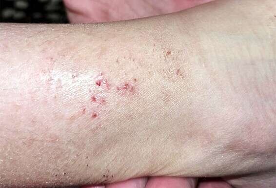 העקיצה החשודה // צילום: דוברות פוריה