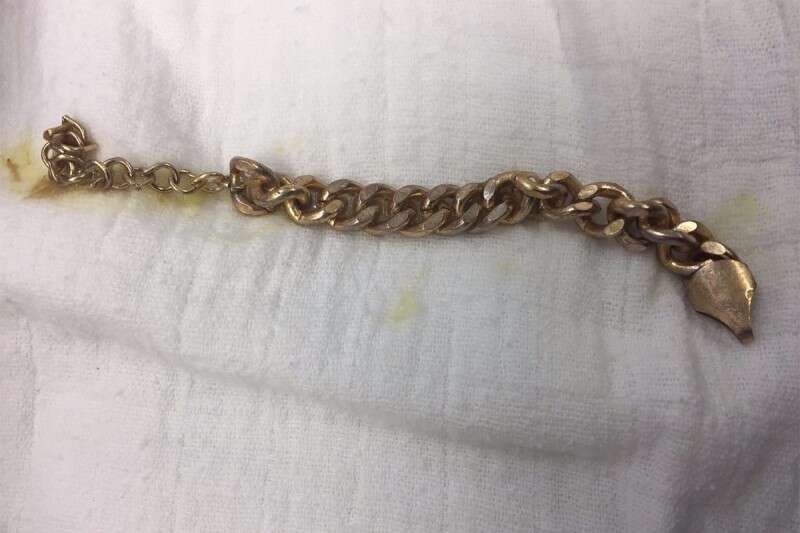 השרשרת לאחר שנשלפה מקיבתו של הילד // צילום: באדיבות ביה"ח רמב"ם