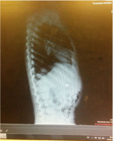 סוללה בקיבתו של בן ה-4 // צילום: דוברות הדסה