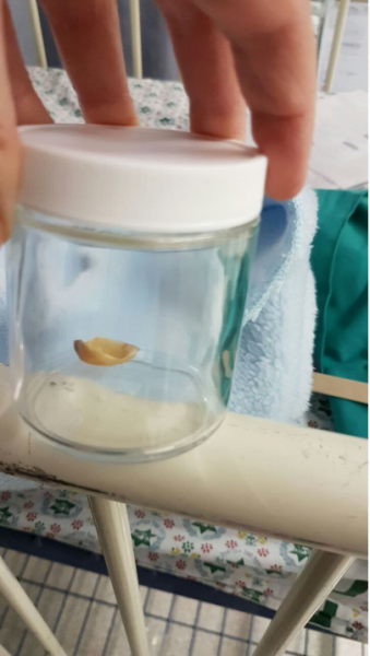 קליפת הפיסטוק שנשלפה מוושט התינוק // צילום: דוברות הדסה