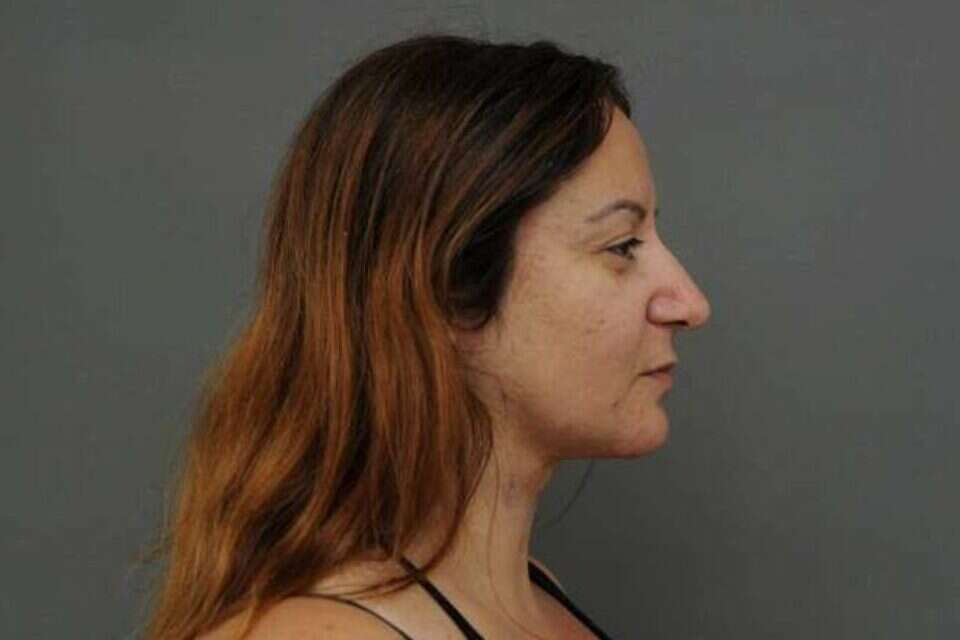 צילום: proportsia_chin_laser_before // proportsia_chin_laser_before ,