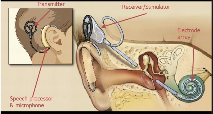 שתל שבלולי // צילום: מתוך פייסבוק