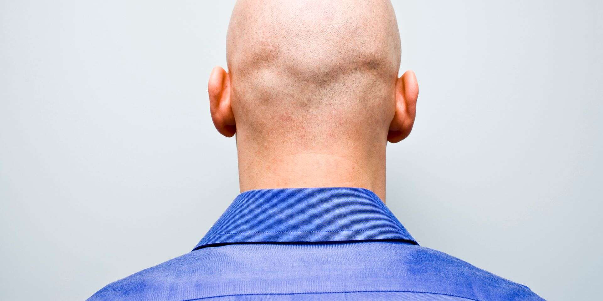 קרחת. אילוסטרציה , GettyImages