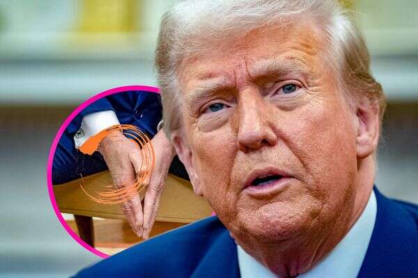 דונלד טראמפ והיד החבולה , EPA, AFP