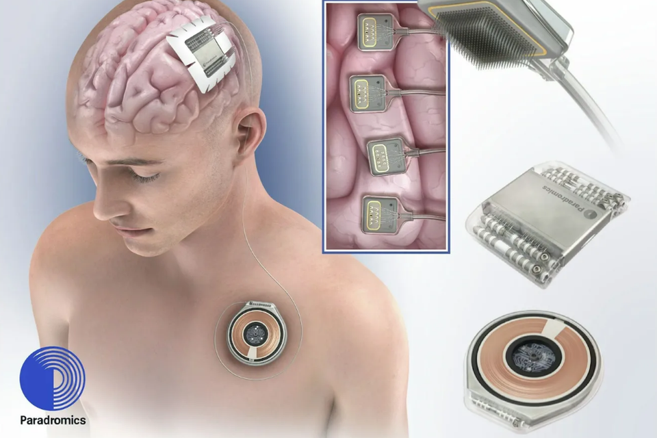 השתל המוחי של חברת Paradromics , Paradromics