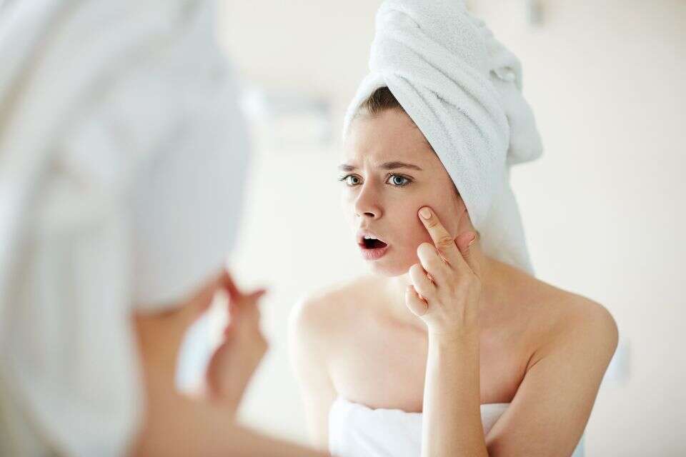 עור הפנים פצעונים אקנה טיפוח ביוטי , istockphoto