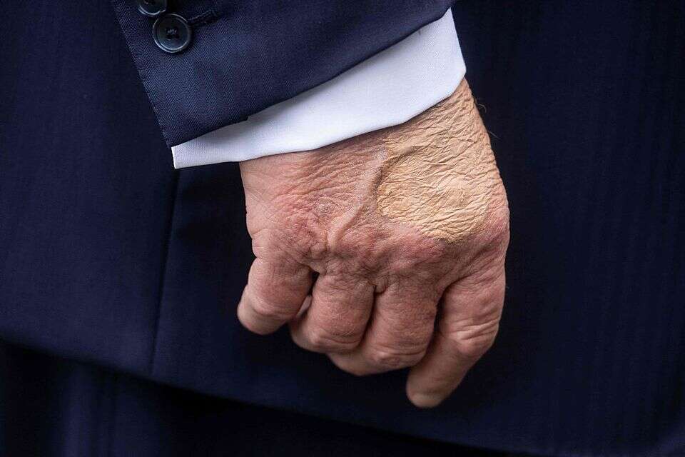 חבורות על ידו של הנשיא טראמפ , איי.אף.פי