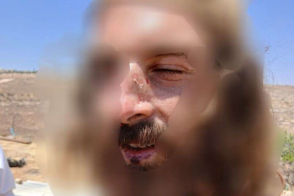 אחד המתיישבים שלטענתו הוכה באגרוף על ידי שוטר מג"ב , ללא