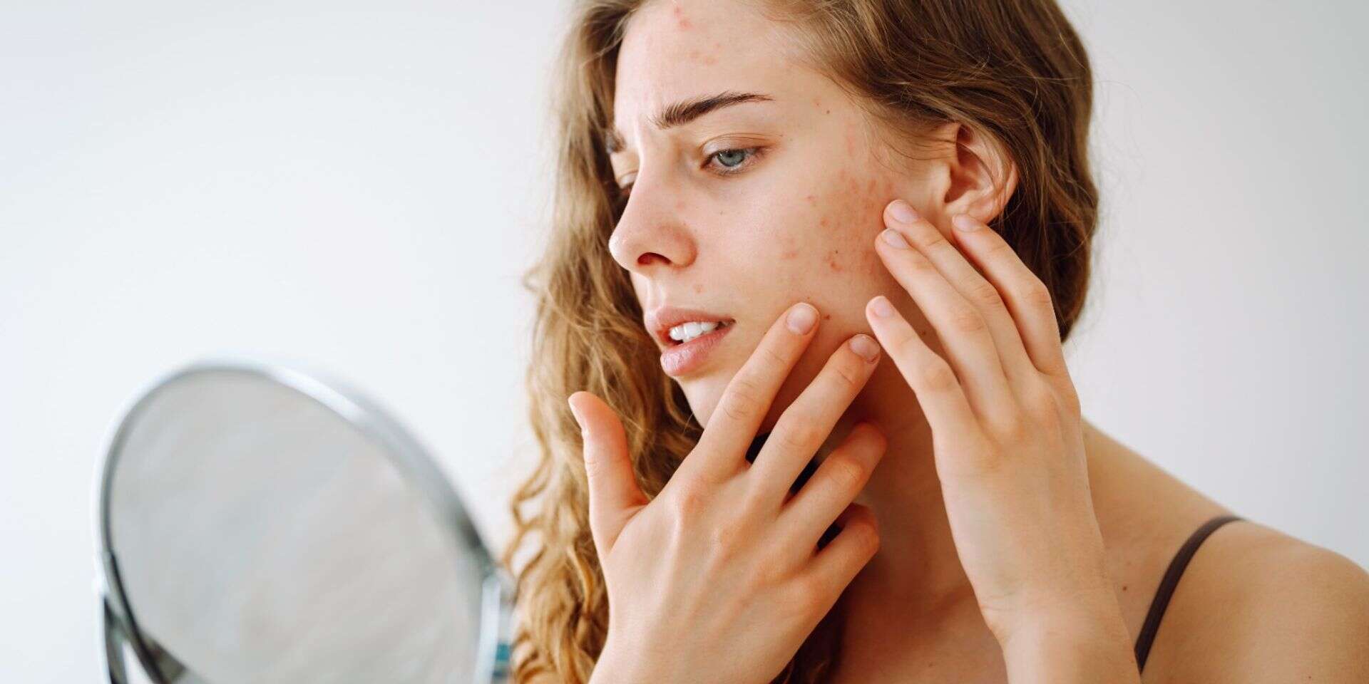 פיגמנטציה אקנה טיפוח העור עור הפנים , istockphoto