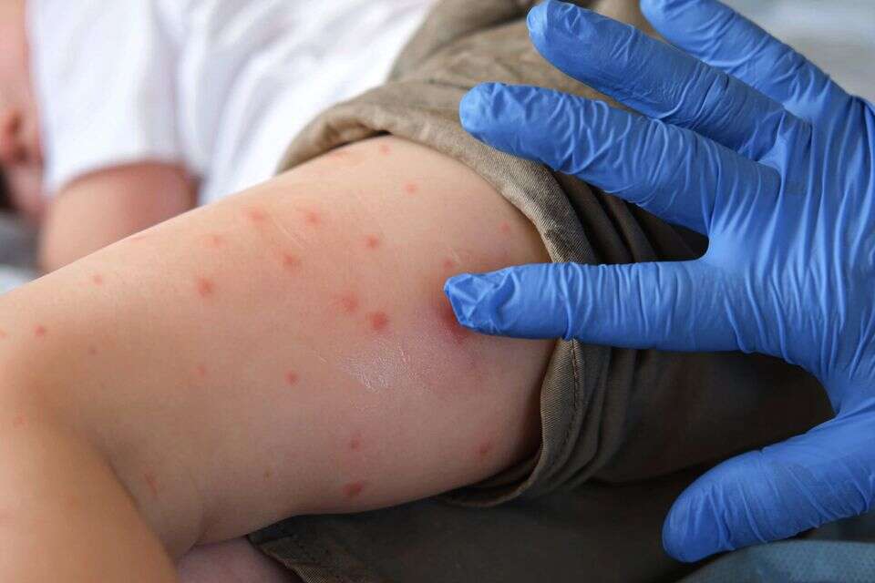 The settlement in the center that was declared as the center of a measles outbreak