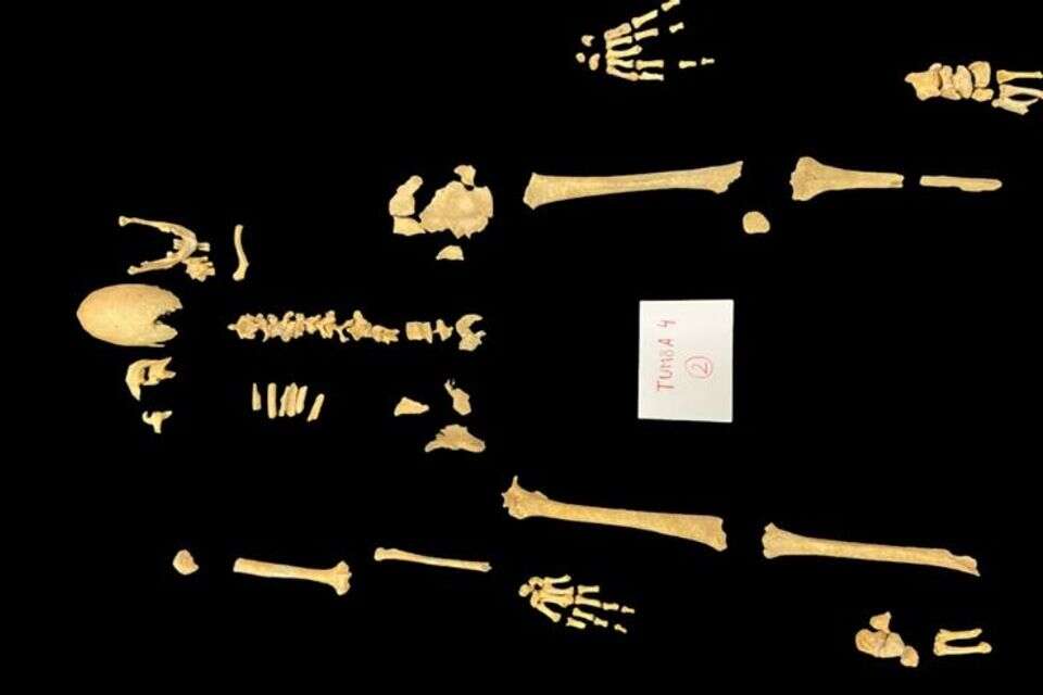 "מעולם לא ראיתי גולגולת כזאת": הסיפור המוזר של מחלת האביר הספרדי