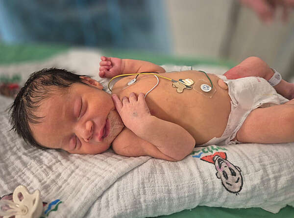 מקרה נדיר: גידול עצום זוהה בעוברית בשבוע 33