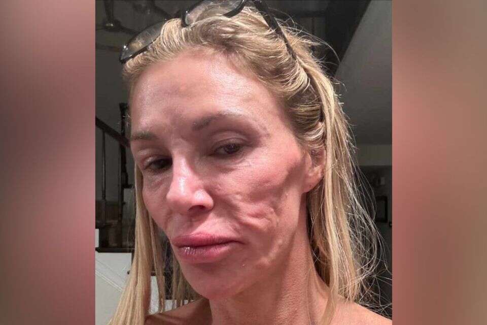 Torn and leaking implants: the reality star's hell