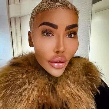 תאונה קוסמטית? "מלך השפתיים" מת בגיל 34