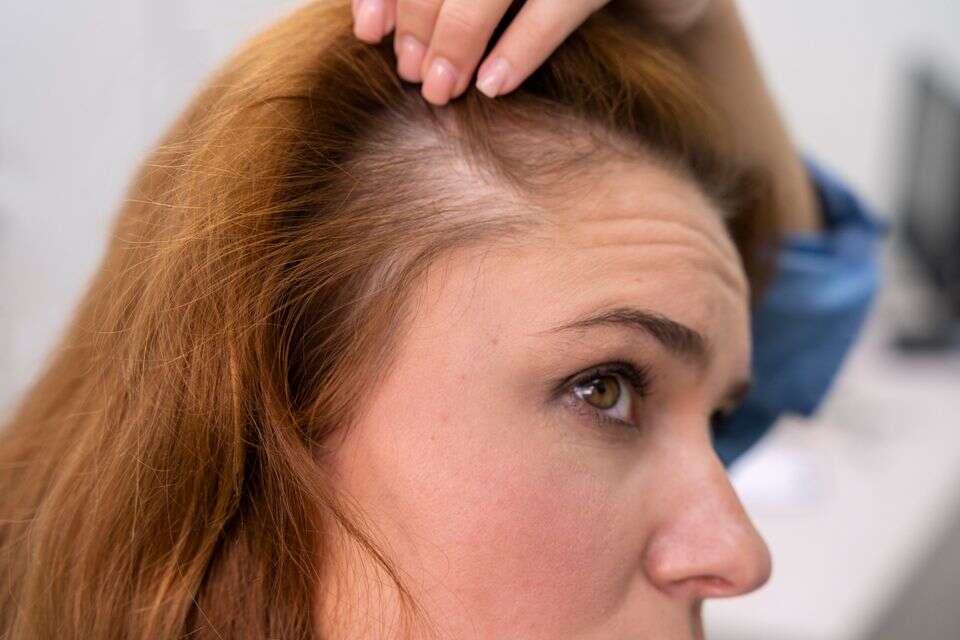 נשירת שיער. אילוסטרציה , GettyImages