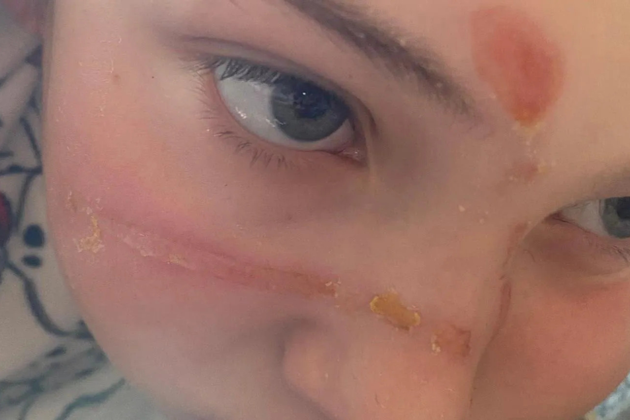Parents, take note: a 10-year-old girl made a trend on TikTok - and was badly burned in the face