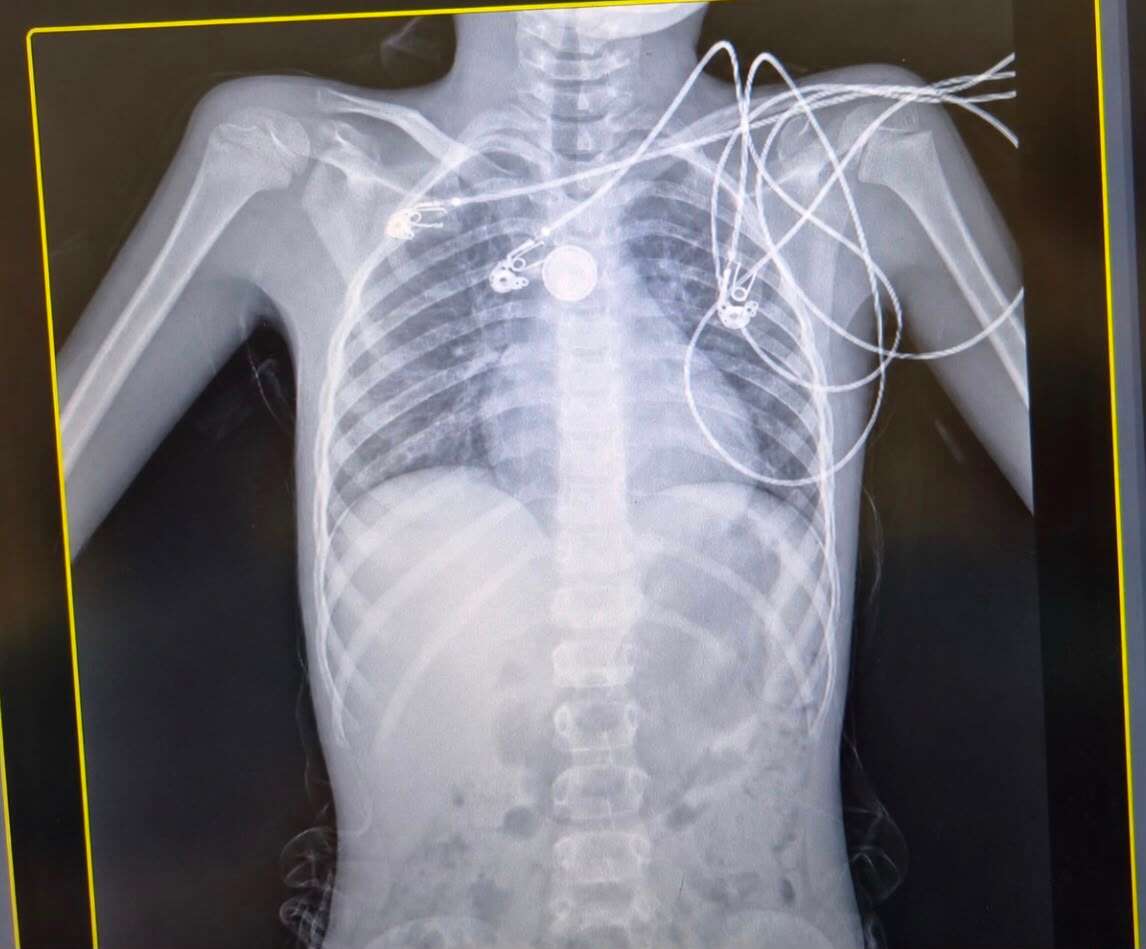 New medical initiative in Israel: How children who have swallowed foreign objects will be treated