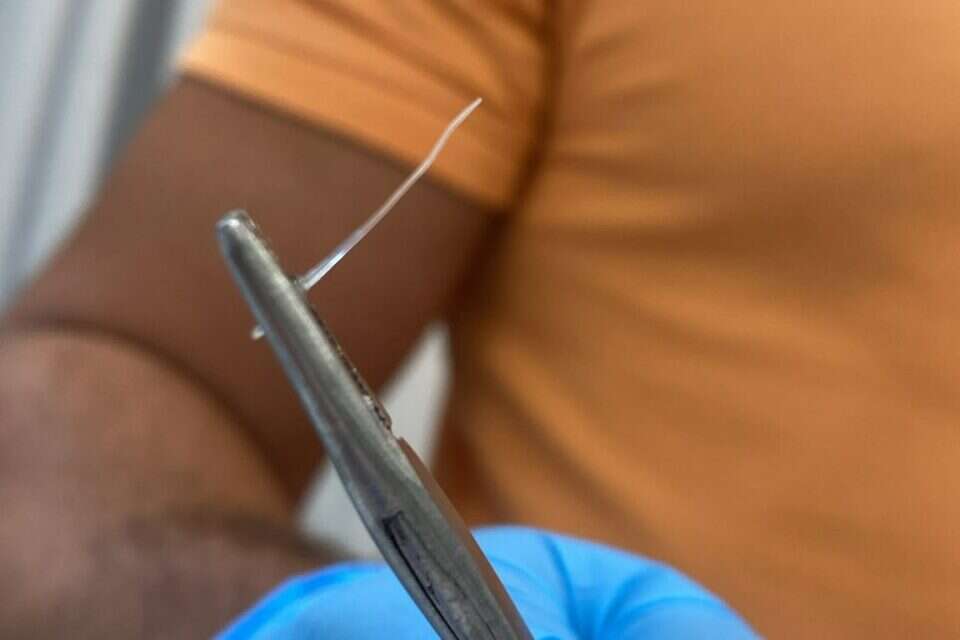 עצם של דג שנתקע בלוע של אחד הילדים , בית חולים "מאוחדת"